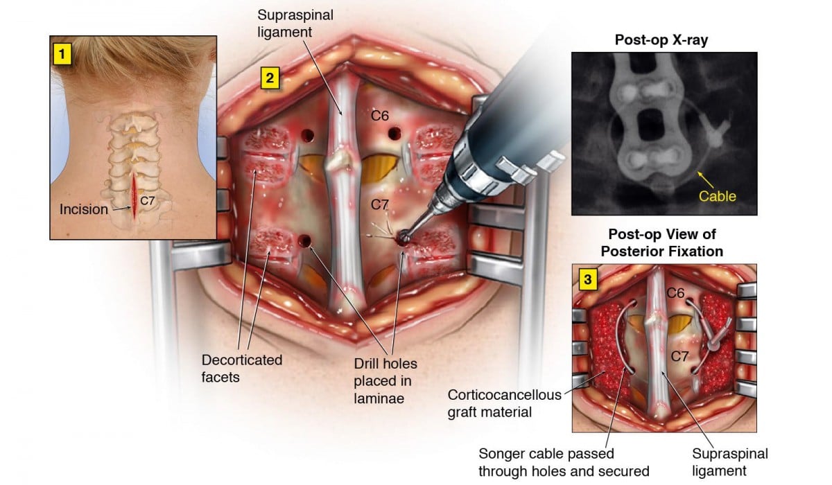 Posterior Cervical Spine Fusion Surgery